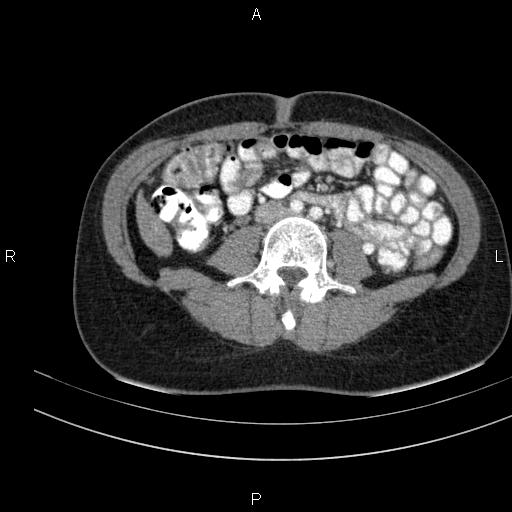 Chronic pancreatitis (Radiopaedia 64576-73450 B 96).jpg