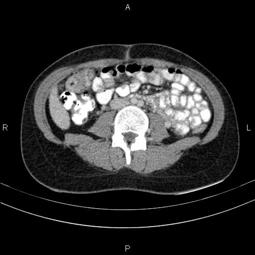 Chronic pancreatitis (Radiopaedia 64576-73450 C 95).jpg