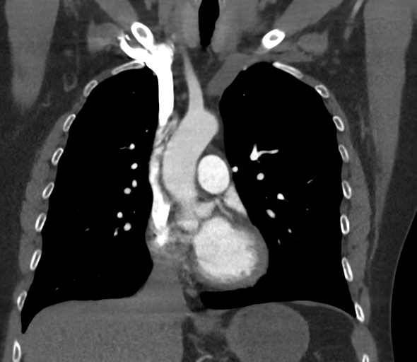 Chronic pulmonary embolus (Radiopaedia 39129-41341 Coronal C+ CTPA 39).png