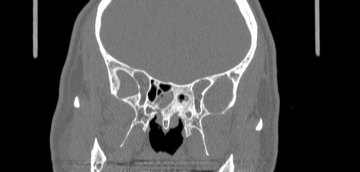 Chronic sphenoidal sinusitis (Radiopaedia 62030-70122 Coronal bone window 101).jpg