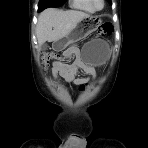 Chronic ureteropelvic junction obstruction (Radiopaedia 78365-90996 B 24).jpg