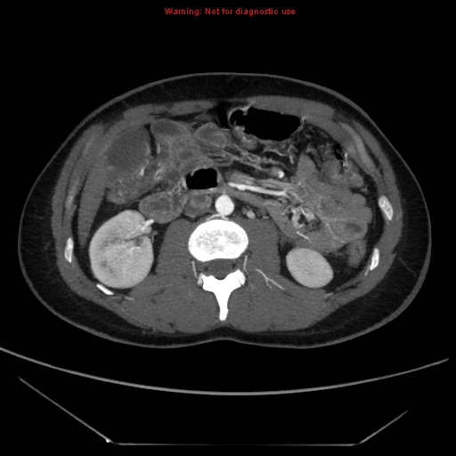 File:Circumaortic left renal vein (Radiopaedia 9069-9792 A 27).jpg