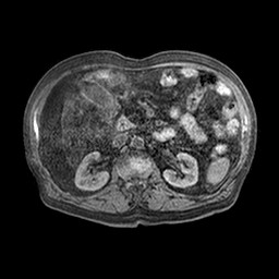 File:Cirrhosis and hepatocellular carcinoma in the setting of hemochromatosis (Radiopaedia 75394-86594 Axial T1 C+ fat sat 20).jpg