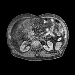 File:Cirrhosis and hepatocellular carcinoma in the setting of hemochromatosis (Radiopaedia 75394-86594 Axial T1 C+ fat sat 23).jpg