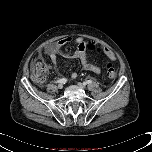 File:Cirrhosis and hepatocellular carcinoma in the setting of hemochromatosis (Radiopaedia 75394-86595 B 64).jpg