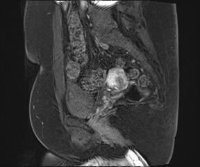 File:Class II Mullerian duct anomaly- unicornuate uterus with rudimentary horn and non-communicating cavity (Radiopaedia 39441-41755 G 69).jpg