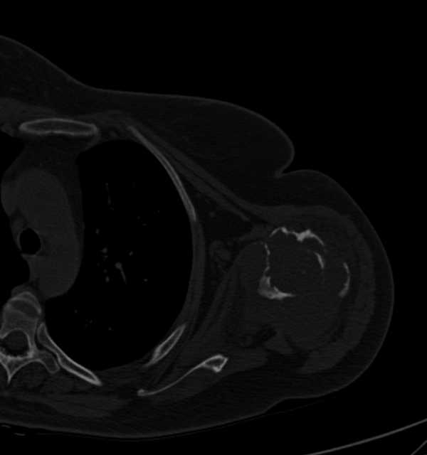 Clear cell chondrosarcoma - humerus (Radiopaedia 63104-71612 Axial bone window 57).jpg