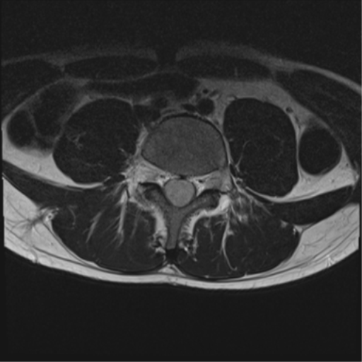 File:Clear cell meningoma - lumbar spine (Radiopaedia 60116-67690 Axial T2 14).png