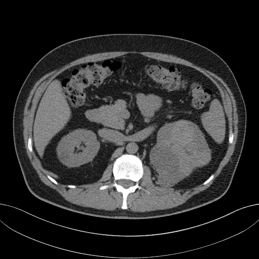 File:Clear cell renal cell carcinoma (Radiopaedia 61449-69393 Axial non-contrast 29).jpg