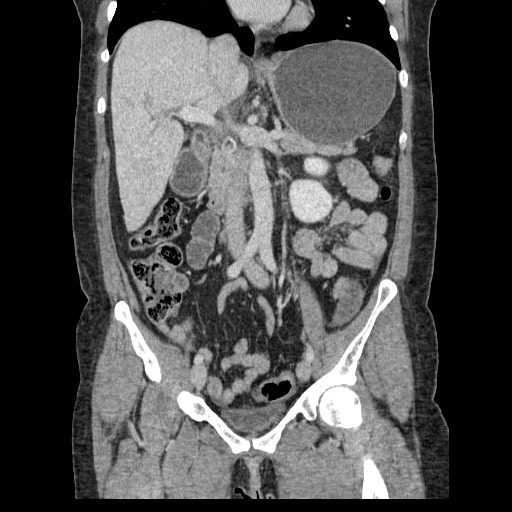 File:Closed loop small bowel obstruction (Radiopaedia 65403-74451 B 54).jpg
