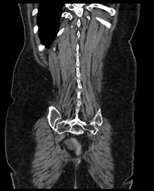 Closed loop small bowel obstruction - adhesions (Radiopaedia 59269-66611 B 110).jpg