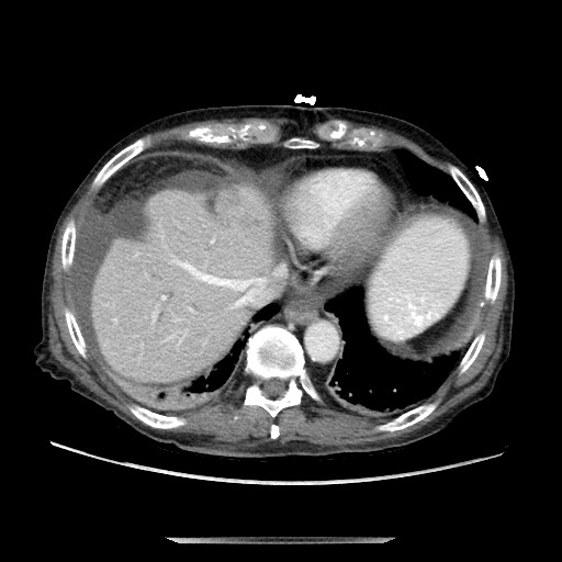 Closed loop small bowel obstruction - adhesive disease and hemorrhagic ischemia (Radiopaedia 86831-102990 A 37).jpg