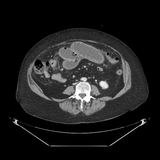 File:Closed loop small bowel obstruction - internal hernia (Radiopaedia 65402-74450 A 73).jpg