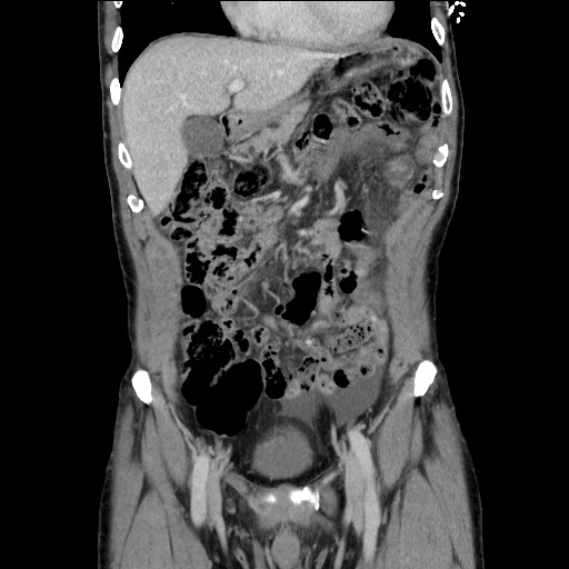 Closed loop small bowel obstruction - omental adhesion causing "internal hernia" (Radiopaedia 85129-100682 B 46).jpg