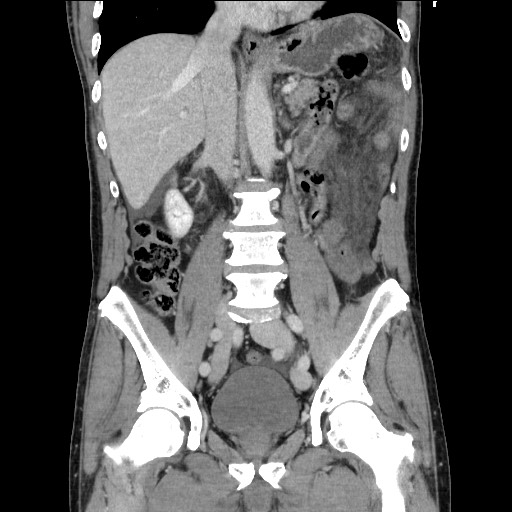 File:Closed loop small bowel obstruction - omental adhesion causing "internal hernia" (Radiopaedia 85129-100682 B 70).jpg