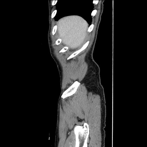 File:Closed loop small bowel obstruction - omental adhesion causing "internal hernia" (Radiopaedia 85129-100682 C 29).jpg