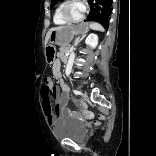 Closed loop small bowel obstruction due to adhesive band, with intramural hemorrhage and ischemia (Radiopaedia 83831-99017 D 119).jpg