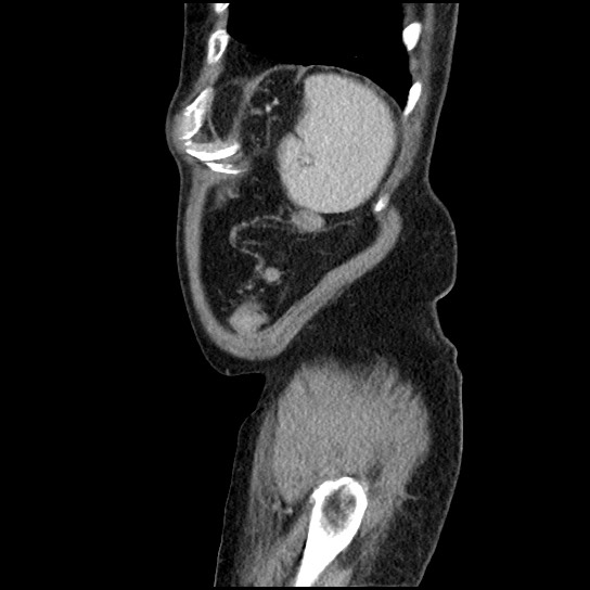 Closed loop small bowel obstruction due to adhesive band - U-shaped loop (Radiopaedia 83829-99012 C 11).jpg