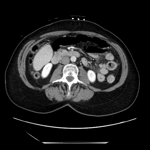 File:Closed loop small bowel obstruction due to adhesive bands - early and late images (Radiopaedia 83830-99014 A 67).jpg