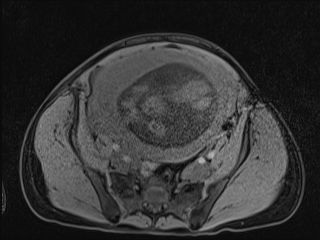 Closed loop small bowel obstruction in pregnancy (MRI) (Radiopaedia 87637-104031 F 39).jpg