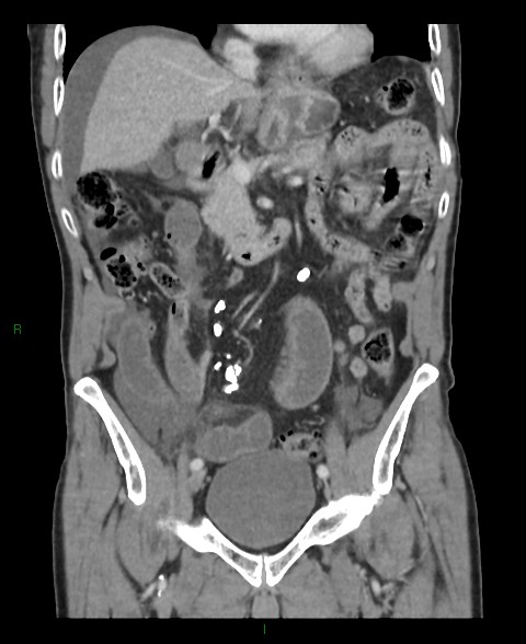 Closed loop small bowel obstruction with ischemia (Radiopaedia 84180-99456 B 38).jpg