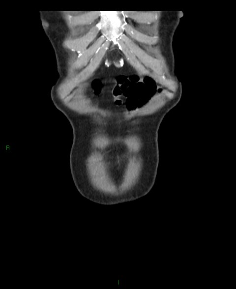 File:Closed loop small bowel obstruction with ischemia (Radiopaedia 84180-99456 B 64).jpg