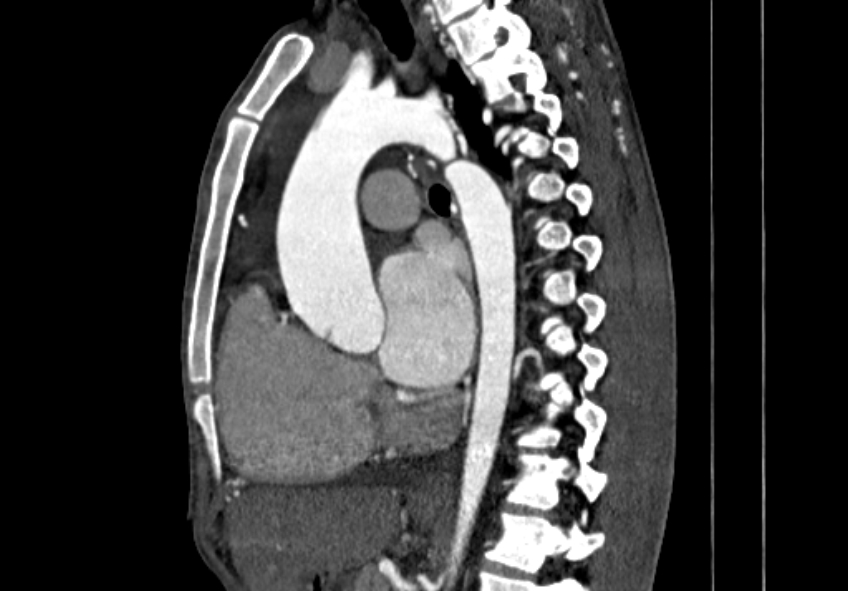 Coarctation of aorta with aortic valve stenosis (Radiopaedia 70463-80574 B 71).jpg