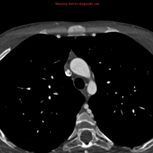 File:Coarctation of the aorta (Radiopaedia 12461-12697 A 73).jpg