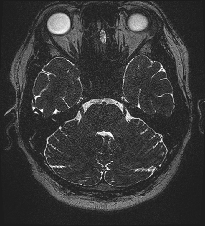Cochlear incomplete partition type III associated with hypothalamic hamartoma (Radiopaedia 88756-105498 Axial T2 94).jpg