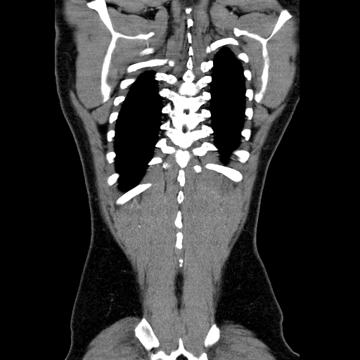 File:Codominant double aortic arch (Radiopaedia 56012-62637 B 43).jpg