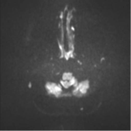 Colloid cyst (Radiopaedia 44510-48181 Axial DWI 30).png
