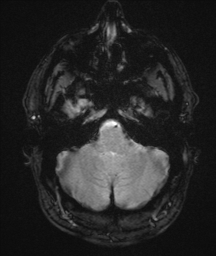 File:Colloid cyst (Radiopaedia 44510-48181 Axial Gradient Echo 6).png