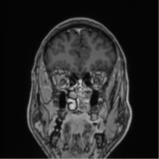 File:Colloid cyst of the third ventricle (Radiopaedia 86571-102662 Coronal T1 C+ 74).png