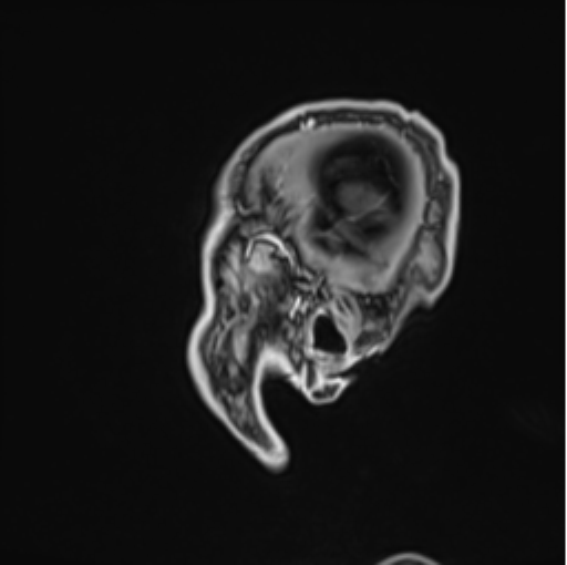 Colloid cyst of the third ventricle (Radiopaedia 86571-102662 Sagittal T1 C+ 6).png