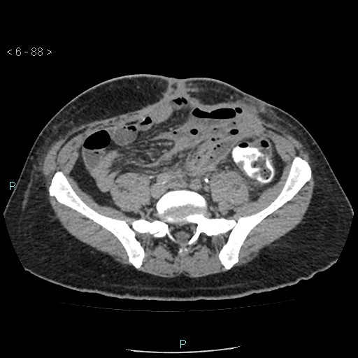 File:Colo-cutaneous fistula (Radiopaedia 40531-43129 A 36).jpg