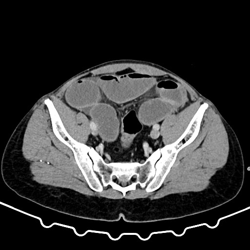 File:Colocolic intussusception due to large lipoma (Radiopaedia 68773-78482 A 154).jpg