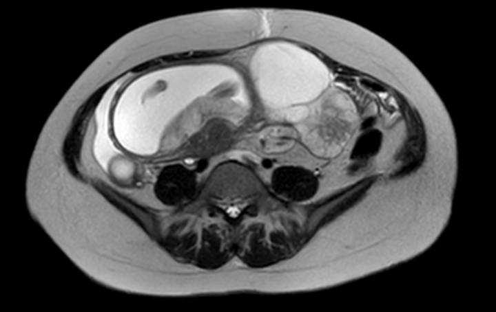 Colon adenocarcinoma with Krukenberg tumors, advanced pregnancy (Radiopaedia 67279-76645 Axial T2 31).jpg
