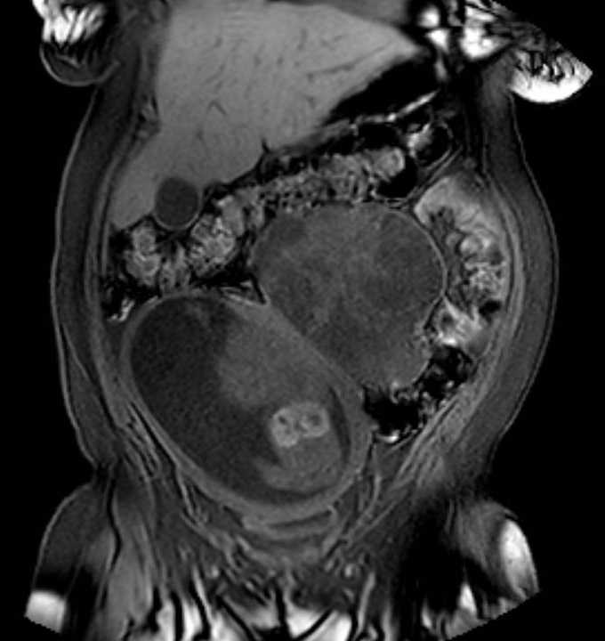 Colon adenocarcinoma with Krukenberg tumors, advanced pregnancy (Radiopaedia 67279-76645 E 22).jpg