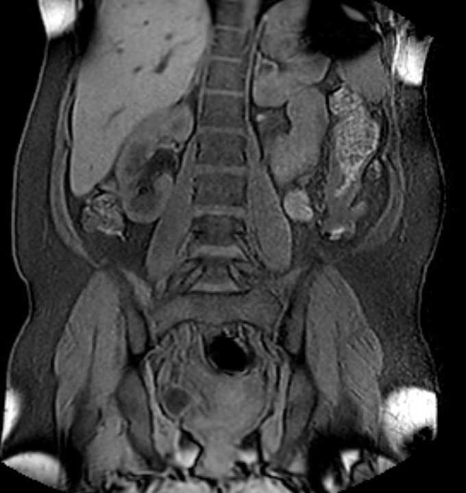 Colon adenocarcinoma with Krukenberg tumors, advanced pregnancy (Radiopaedia 67279-76645 E 61).jpg