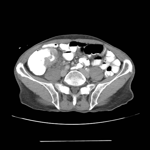 File:Colon cancer with calcified liver metastasis (Radiopaedia 74423-85307 A 52).jpg