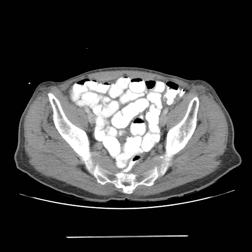 File:Colon cancer with calcified liver metastasis (Radiopaedia 74423-85307 A 64).jpg