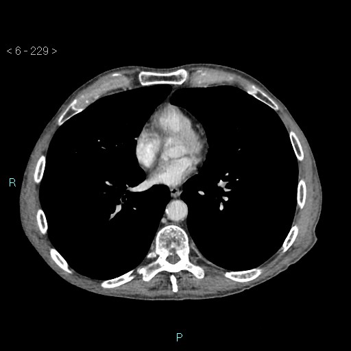 File:Colonic cancer (ultrasound and TC imaging) (Radiopaedia 50346-55713 B 229).jpg