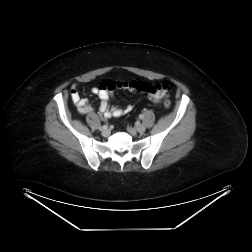 File:Colonic intussusception due to adenocarcinoma (Radiopaedia 86828-102987 A 112).jpg