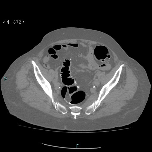 Colonic lipomas (Radiopaedia 49137-54244 Axial bone window 166).jpg