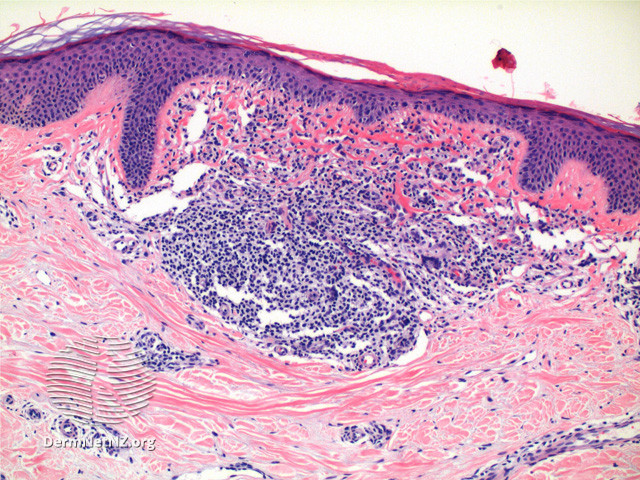 File:Figure 3 (DermNet NZ pathology-t-lichennitidusfigure3).jpg
