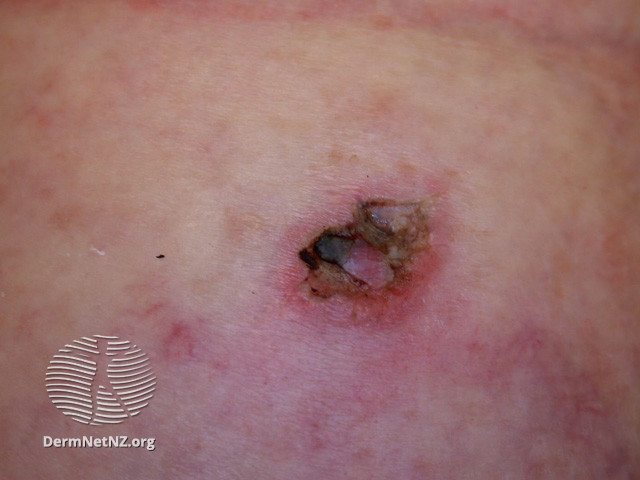 Intraepidermal carcinoma (DermNet NZ lesions-scc-in-situ-2929).jpg