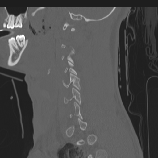 File:Multitrauma with diffuse axonal injury, temporal bone fractures and traumatic caroticocavernous fistula (Radiopaedia 37242-39035 Sagittal 34).png