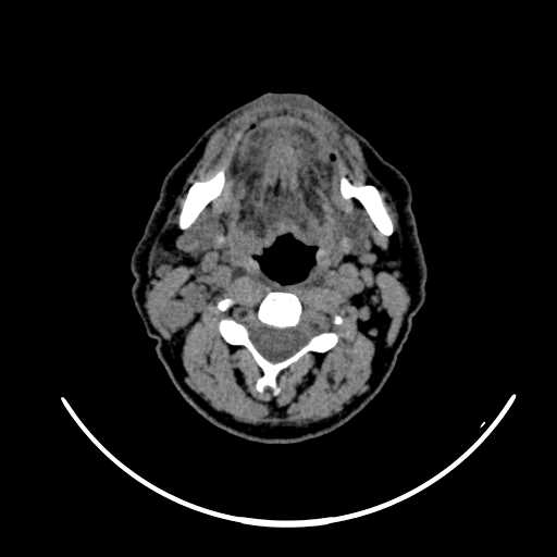 File:Nasopharyngeal carcinoma - infiltrating the clivus (Radiopaedia 62583-70875 Axial non-contrast 35).jpg