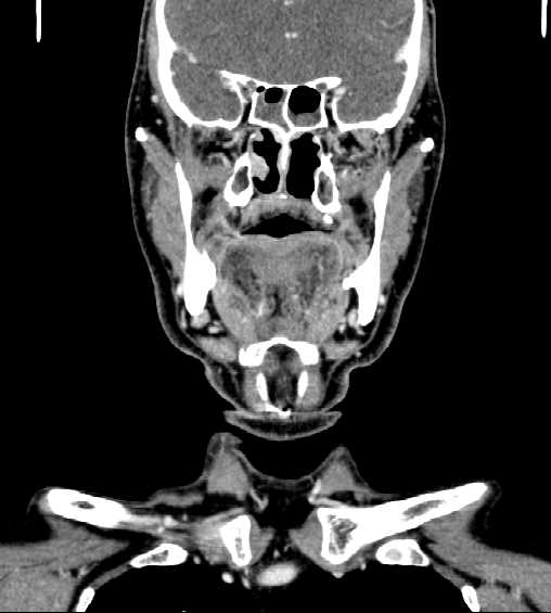 File:Nasopharyngeal carcinoma - infiltrating the clivus (Radiopaedia 62583-70875 D 14).jpg