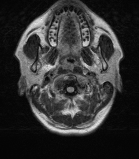 File:Nasopharyngeal carcinoma with pterygopalatine fossa involvement (Radiopaedia 33102-34134 Axial FLAIR 1).png